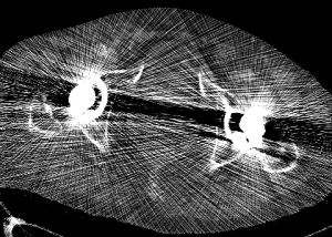Артефакты — помехи на компьютерной томограмме таза, возникшие из-за металлических протезов тазобедренных суставов 